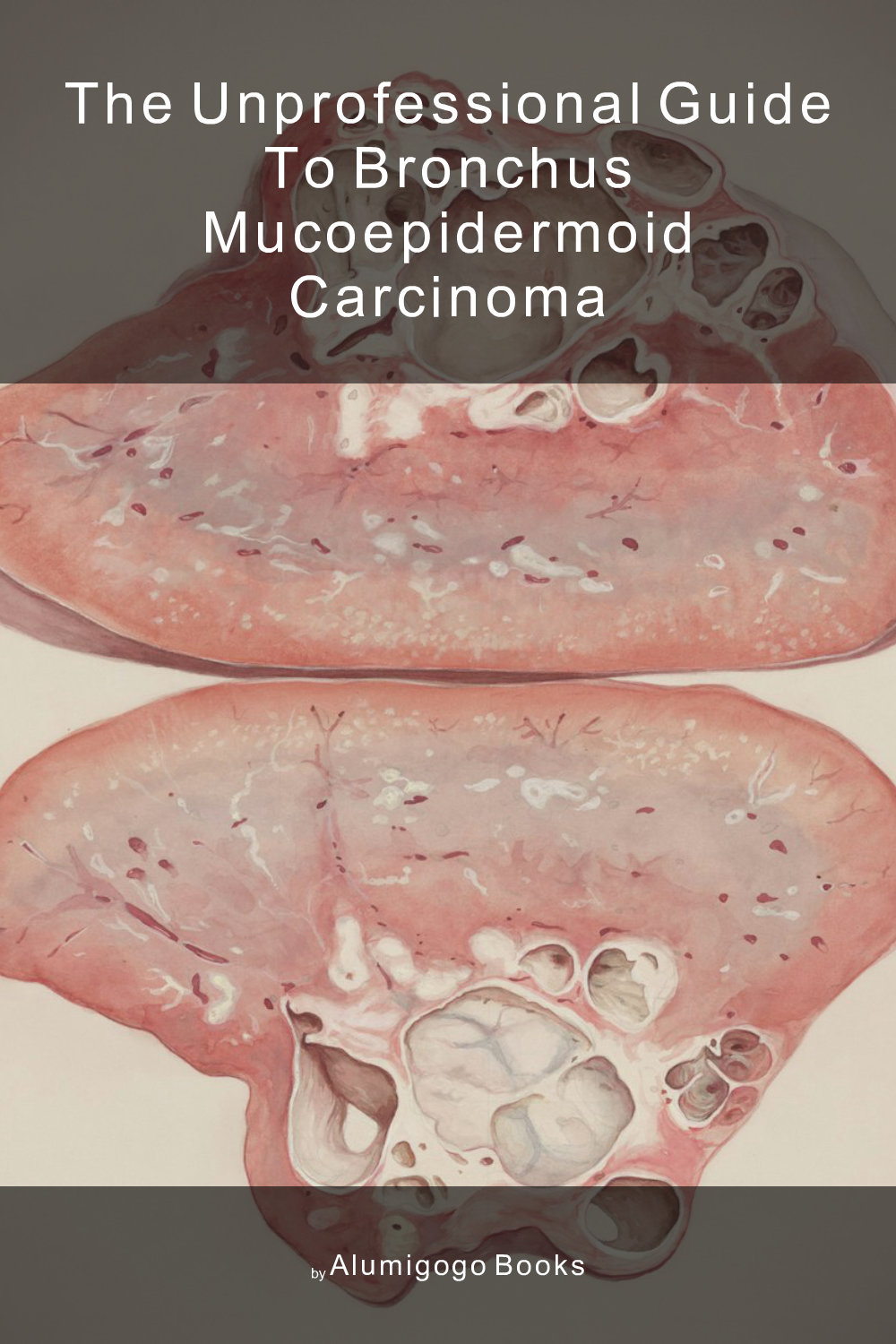 Cover of The Unprofessional Guide to bronchus mucoepidermoid carcinoma