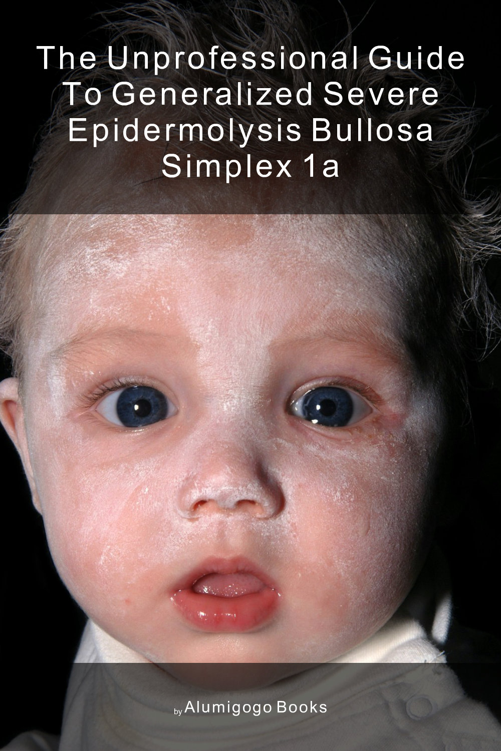 Cover of The Unprofessional Guide to generalized severe epidermolysis bullosa simplex 1A