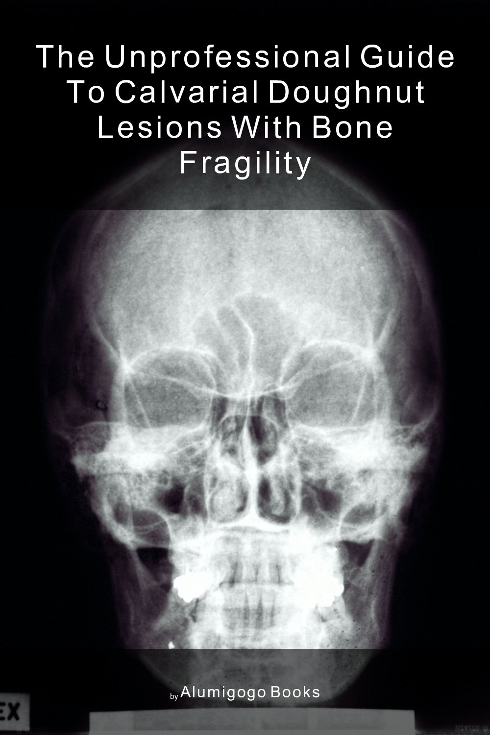 Cover of The Unprofessional Guide to calvarial doughnut lesions with bone fragility