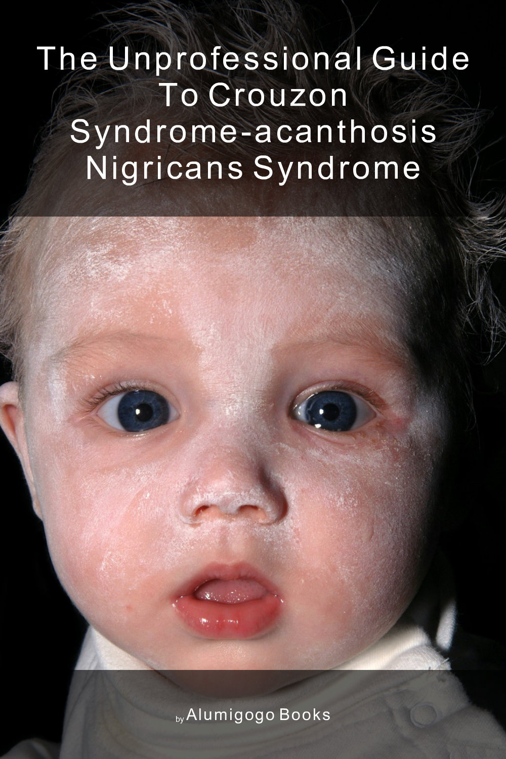 Cover of The Unprofessional Guide to Crouzon syndrome-acanthosis nigricans syndrome